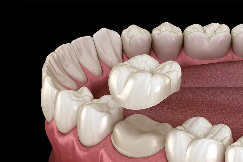 Dental crown example model